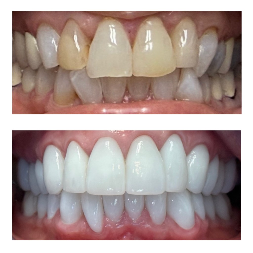 dental crowns before and after